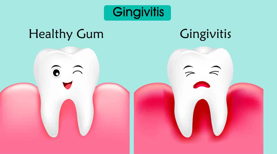 Gingivite : comment soigner une gingivite ?